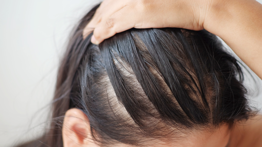 What is Alopecia?